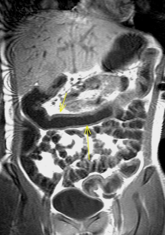 Figure 5 for case Enteropathic arthropathy
